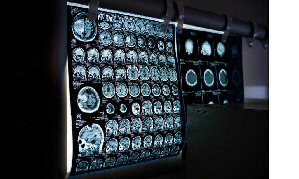 Detailed brain MRI films showing discounted & low-cost diagnostic imaging in Houston for neurology health checks.